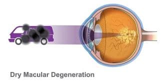 DRY AMD