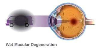 WET AMD
