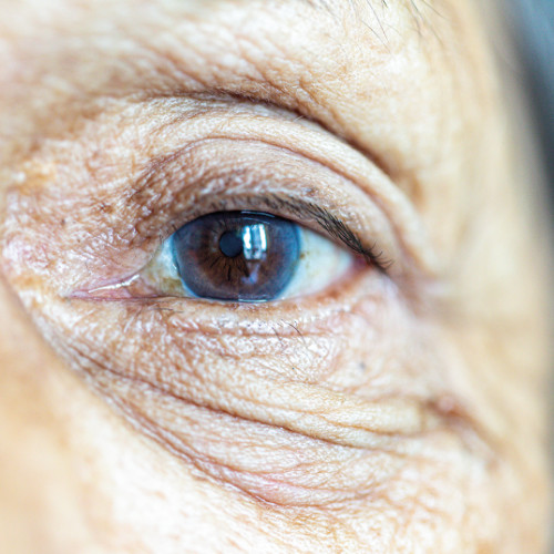 (AMD) Age-related Macular Degeneration