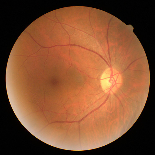 Diabetic Macular Oedema (DMO)