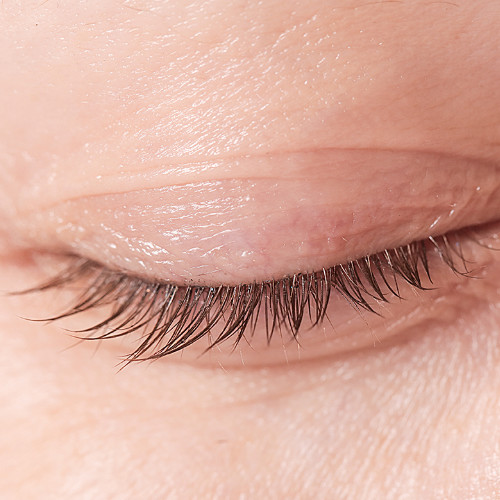 Blepharitis: inflammation of the eyelids