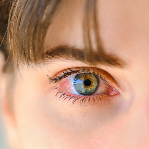 Dry eye disease (DED)